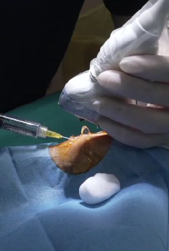 Injection échoguidée en conditions réelles